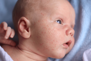 How To Treat and Prevent Baby Acne