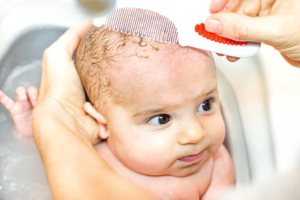 How To Treat and Prevent Baby Cradle Cap